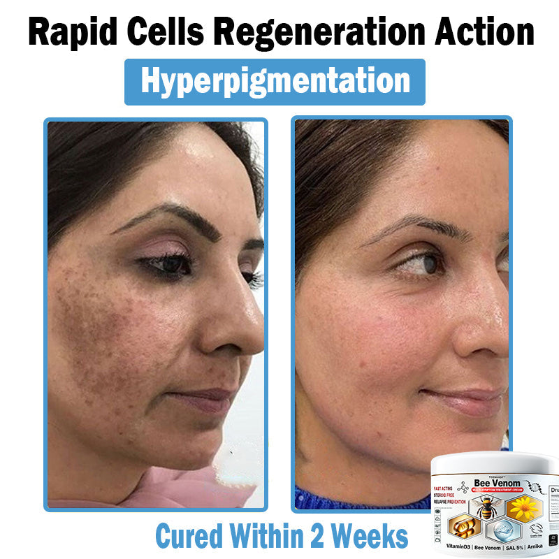 TODAHOF™ Bee Venom Multi-Symptom Skin Treatment Cream (🛡️NPF RECOMMENDS)