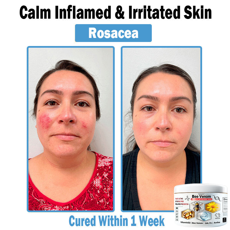 TODAHOF™ Bee Venom Multi-Symptom Skin Treatment Cream (🛡️NPF RECOMMENDS)