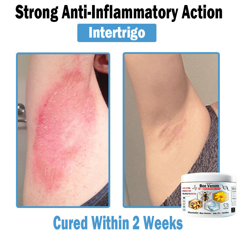 TODAHOF™ Bee Venom Multi-Symptom Skin Treatment Cream (🛡️NPF RECOMMENDS)