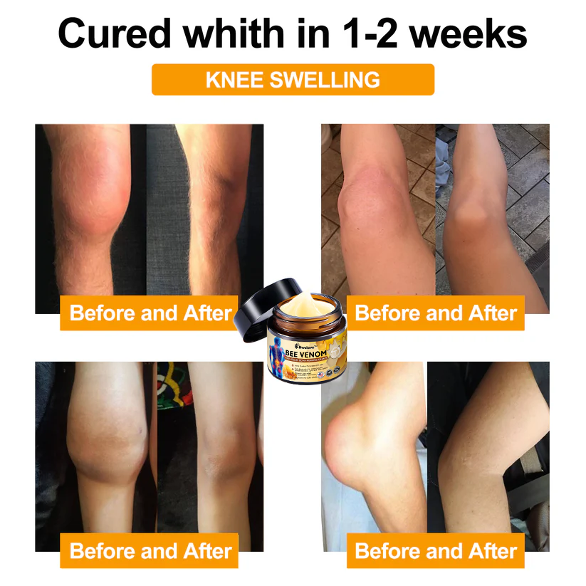 Official Store:Awzlove™ Bee Venom Arthritis Therapy Cream(Specially for older adults & AAOS recommends)🎁