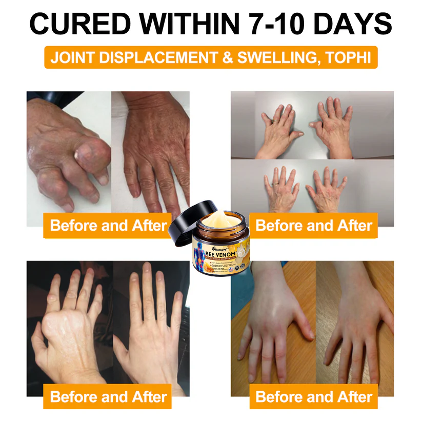 Official Store:Awzlove™ Bee Venom Arthritis Therapy Cream(Specially for older adults & AAOS recommends)🎁