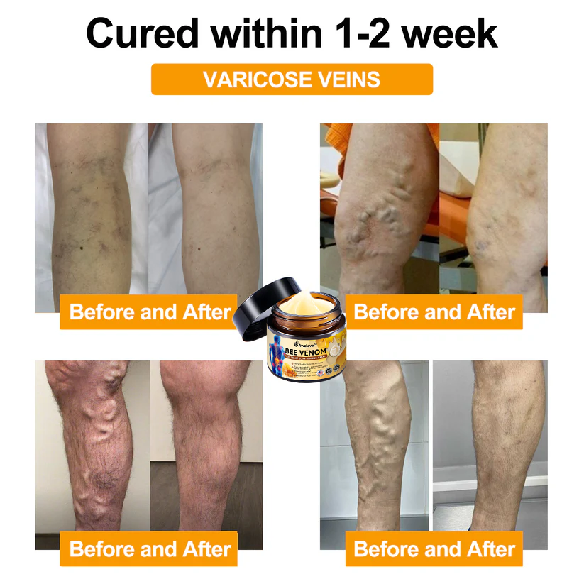 Official Store:Awzlove™ Bee Venom Arthritis Therapy Cream(Specially for older adults & AAOS recommends)🎁