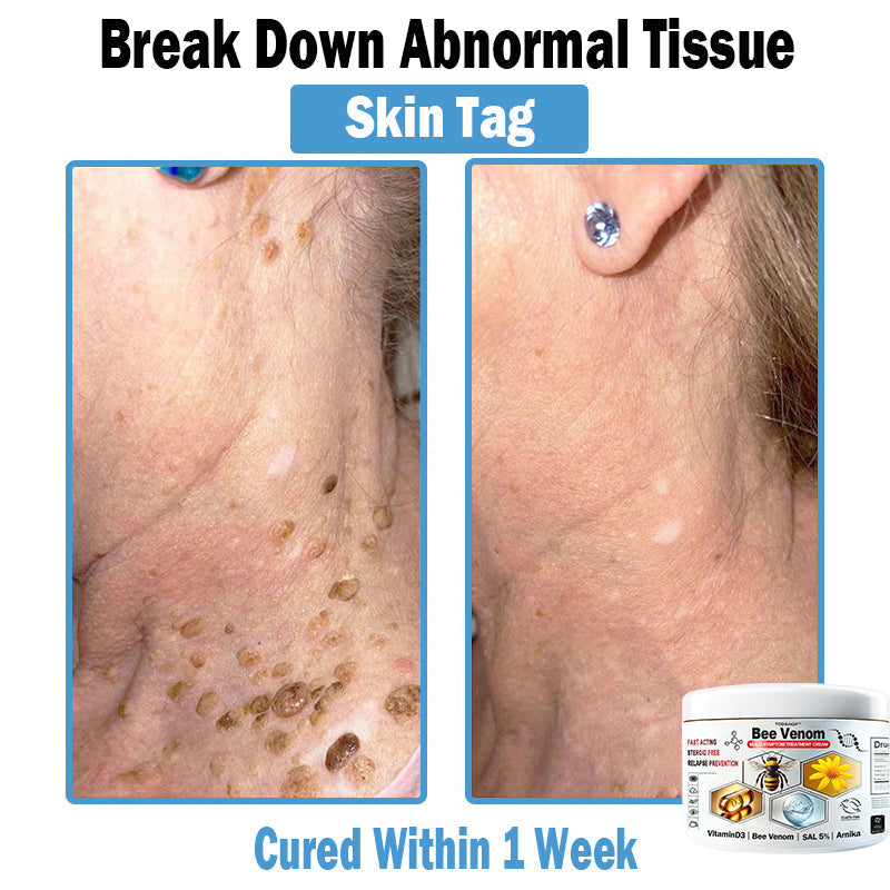 TODAHOF™ Bee Venom Multi-Symptom Skin Treatment Cream (🛡️NPF RECOMMENDS)