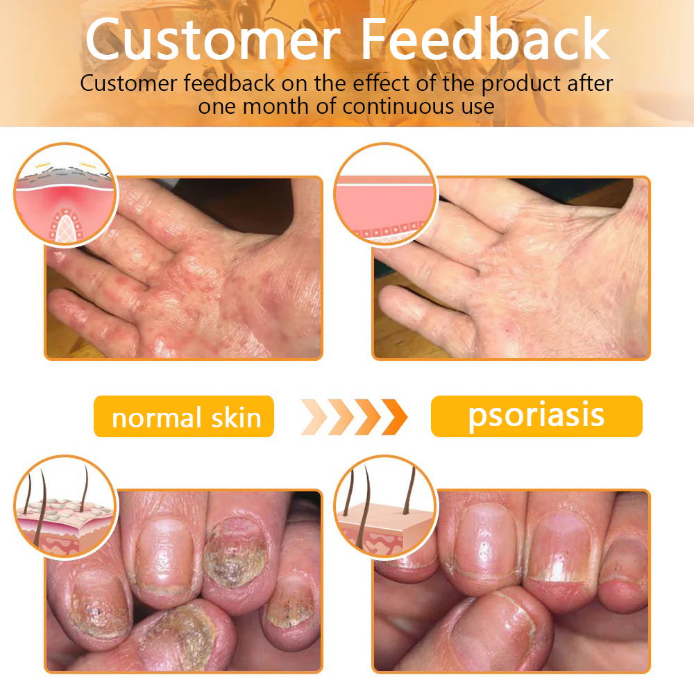 πποΌπ΄π΄π· π
πππππππππποΌππ’ππππ’β’ Bee Venom Skin Treatment Cream(π₯Last day promotion 80% off)