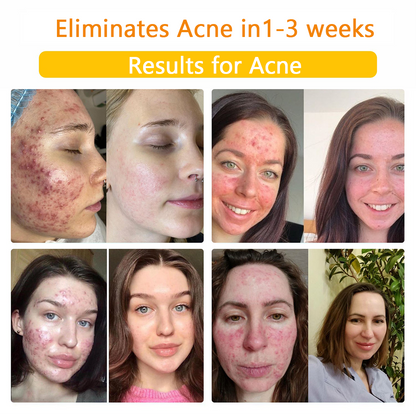 🎉🎉（𝐴𝐴𝐷 𝑅𝑒𝑐𝑜𝑚𝑚𝑒𝑛𝑑𝑒𝑑）𝑇𝑢𝑟𝑜𝑛𝑢™ Bee Venom Skin Treatment Cream(🔥Last day promotion 80% off)